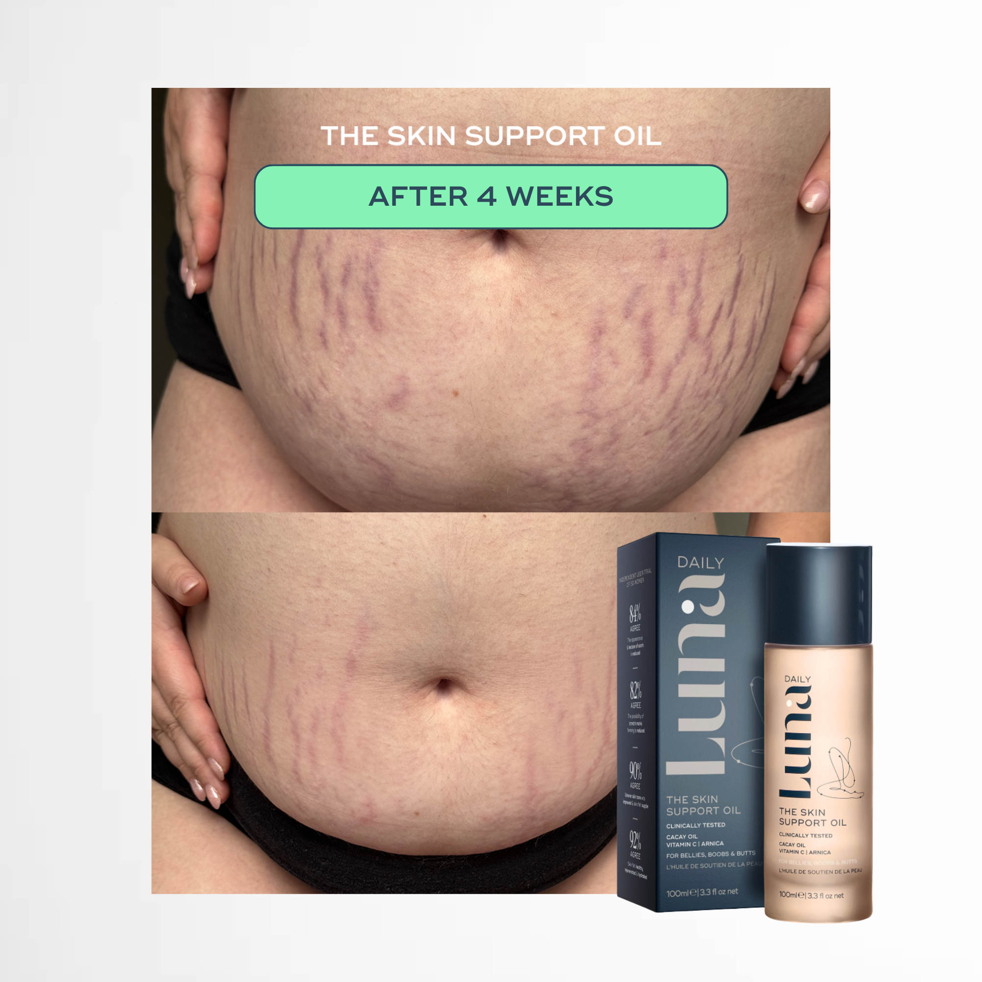 The Skin Support Oil - For Stretch Marks