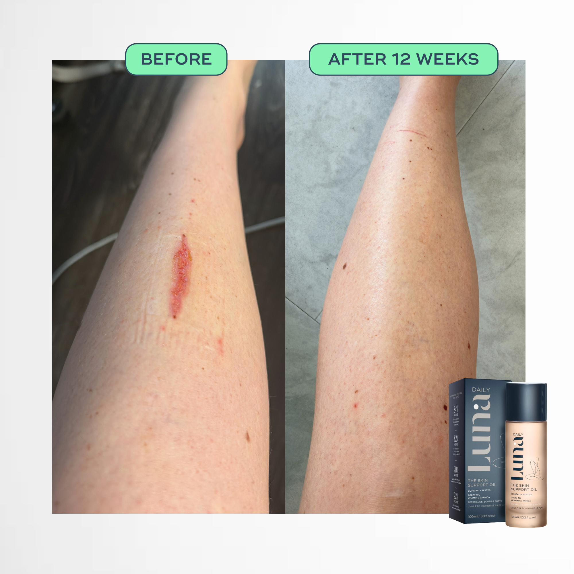 The Skin Support Oil - For Stretch Marks