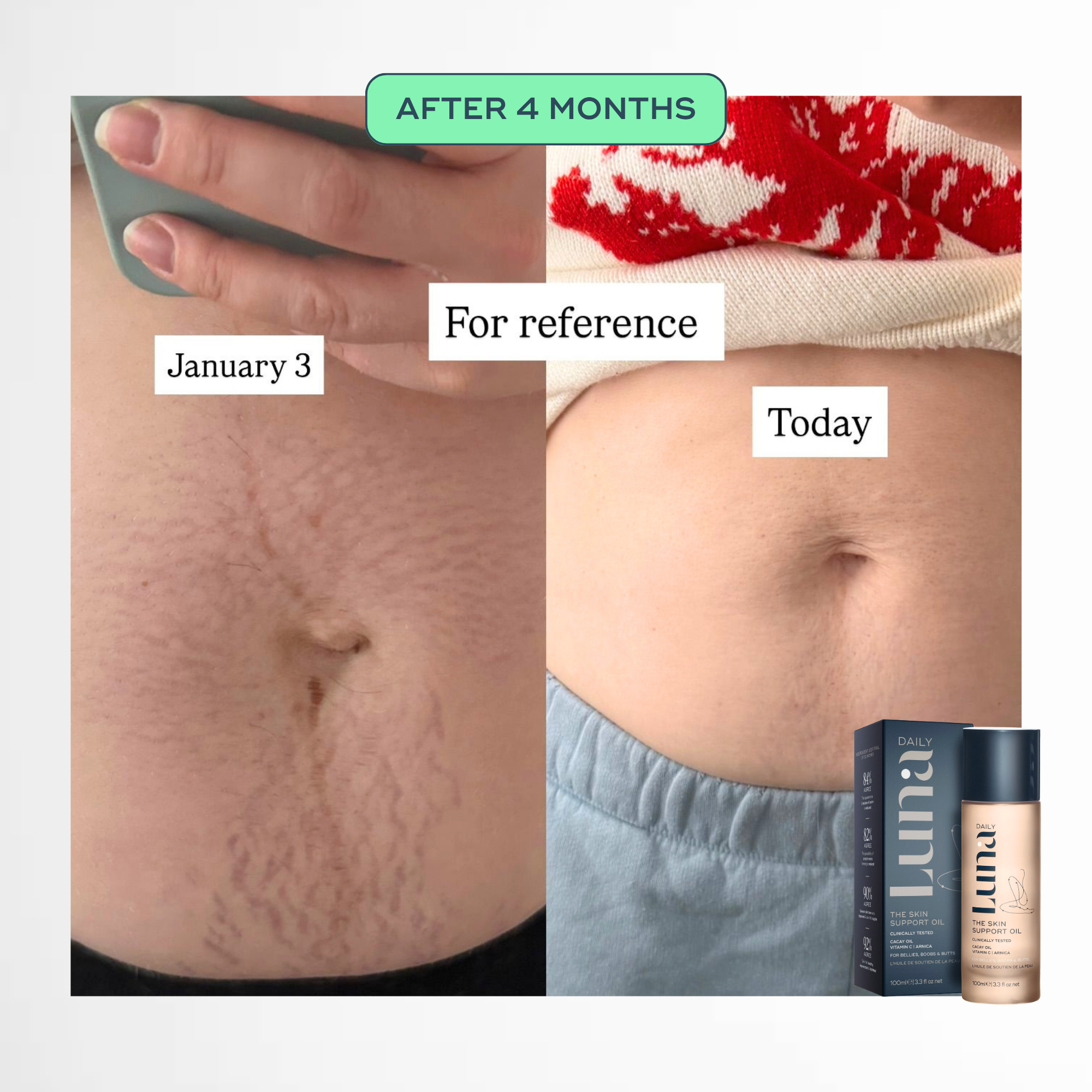 The Skin Support Oil - For Stretch Marks