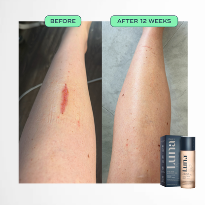 The Skin Support Oil - For Stretch Marks
