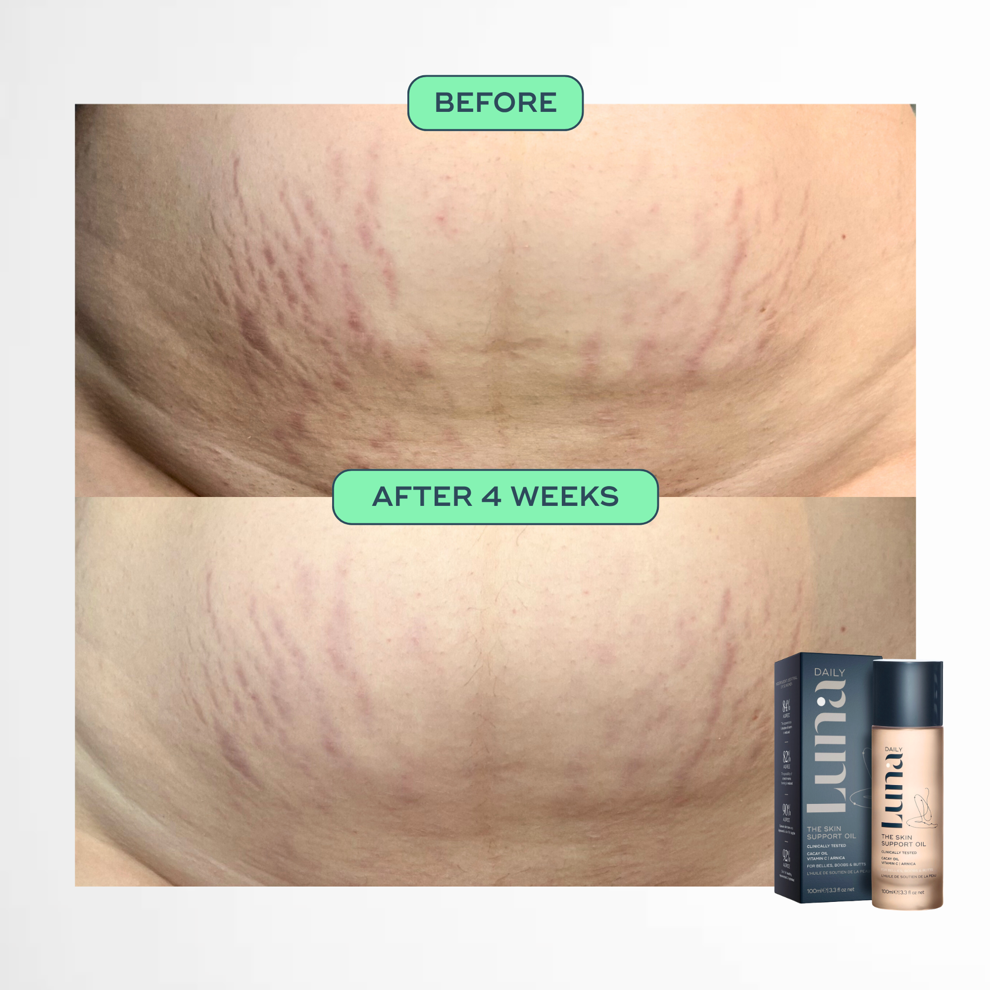 The Skin Support Oil - For Stretch Marks