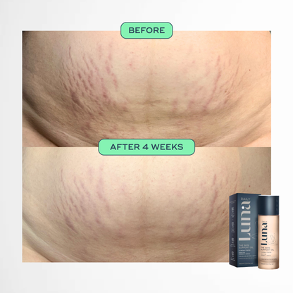 The Skin Support Oil - For Stretch Marks