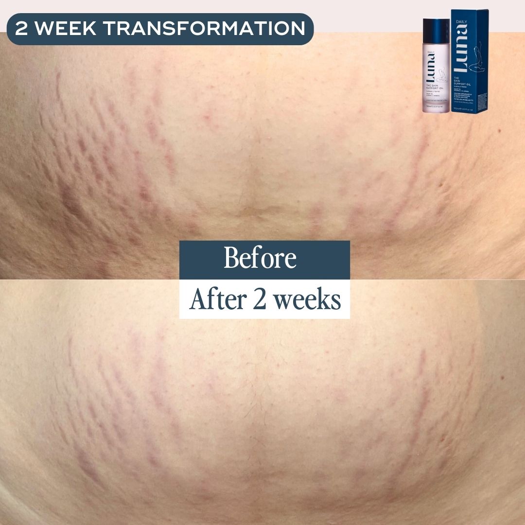 THE SKIN SUPPORT OIL - FOR STRETCH MARKS - Luna Daily - #