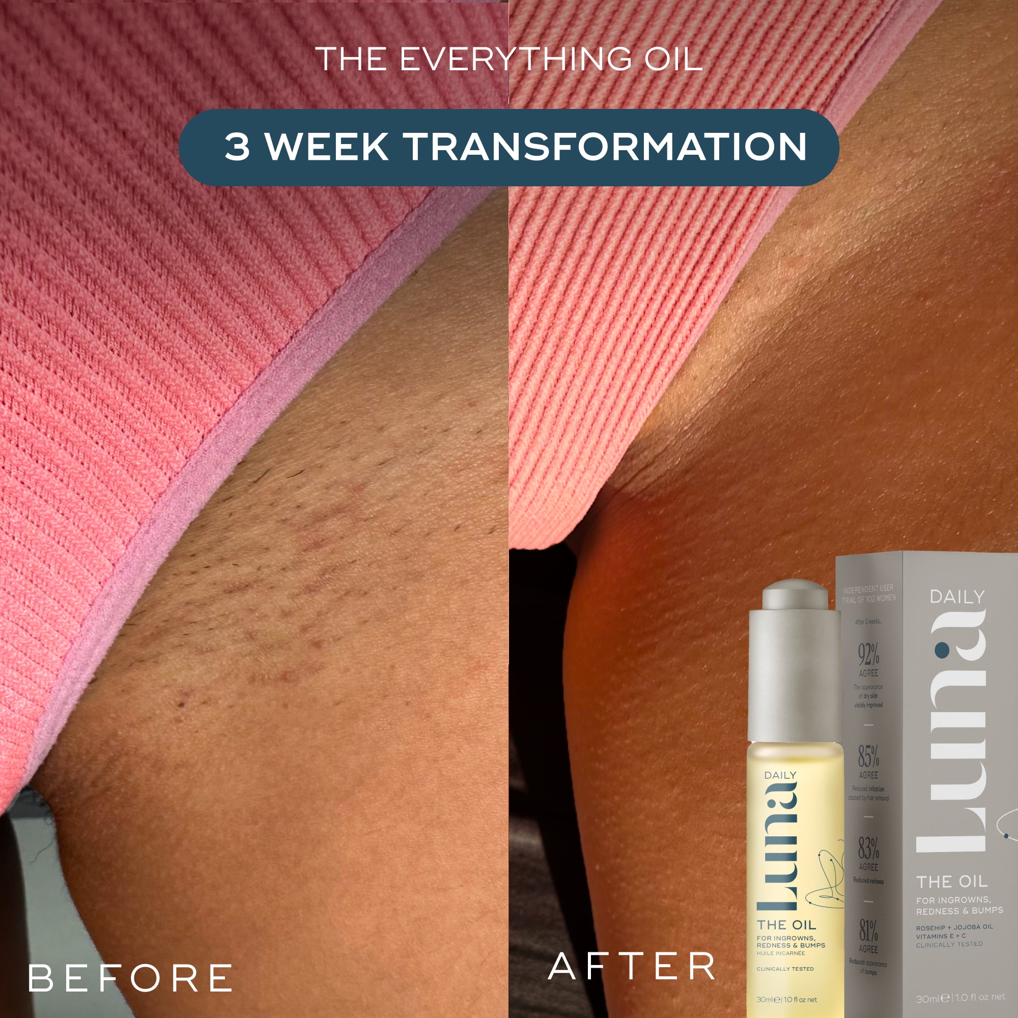 Smooth Skin Saviours - Rid Ingrowns, Redness + Bumps in 2 weeks (+ FREE Lotion worth $26)