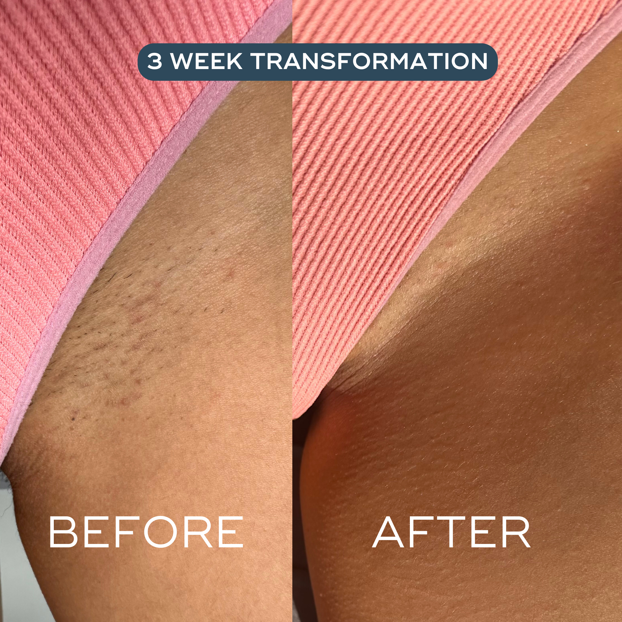 The Oil - For Ingrowns & Bumps